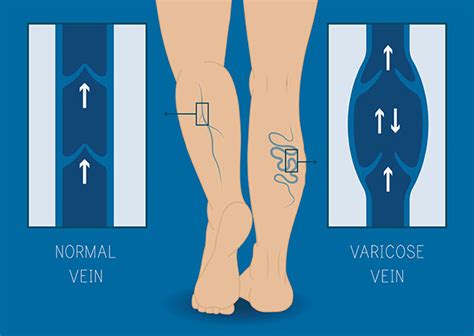 Lower extremity venous reflux 